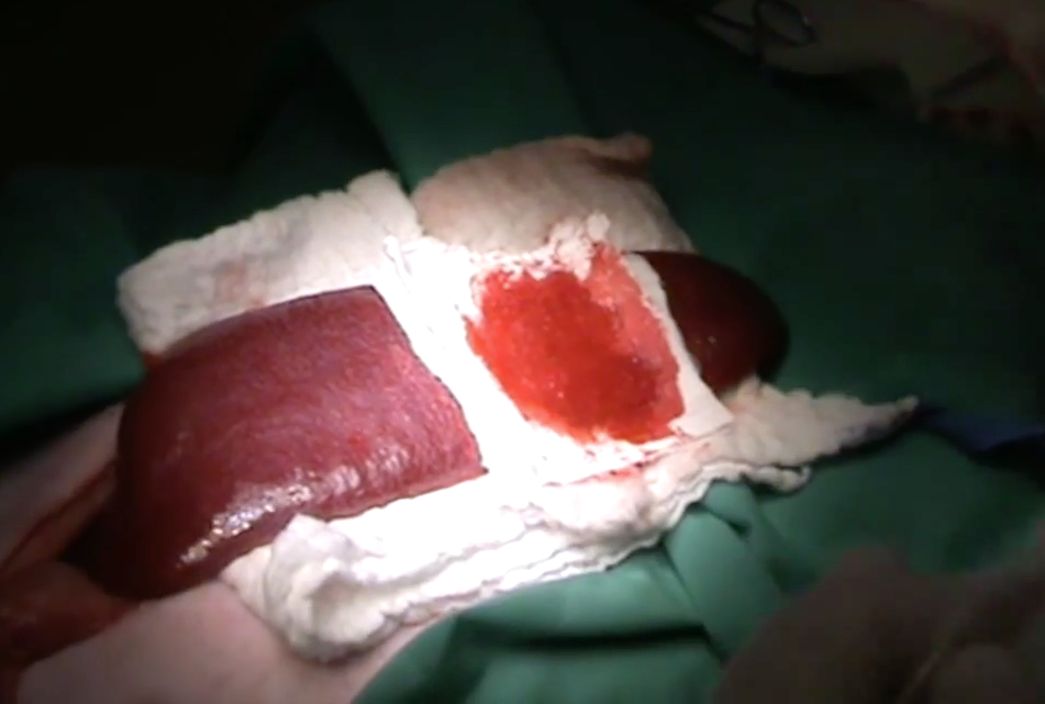 severe bleeding bandage stops israeli saver another blood clotting